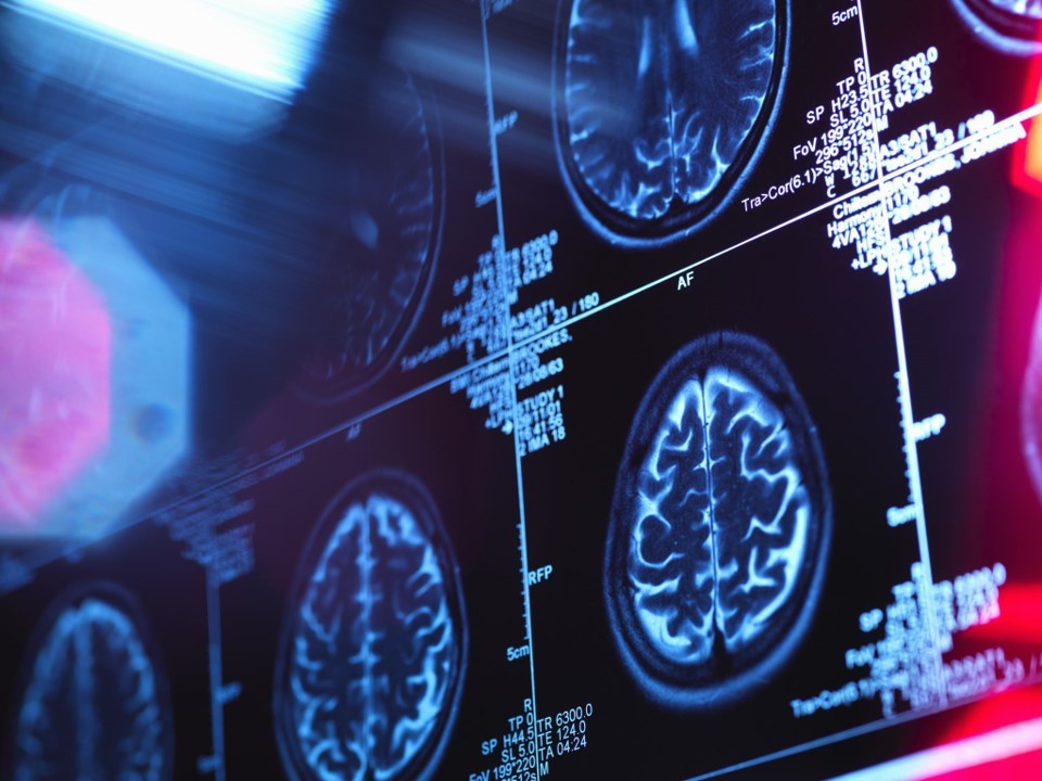 Brain scan